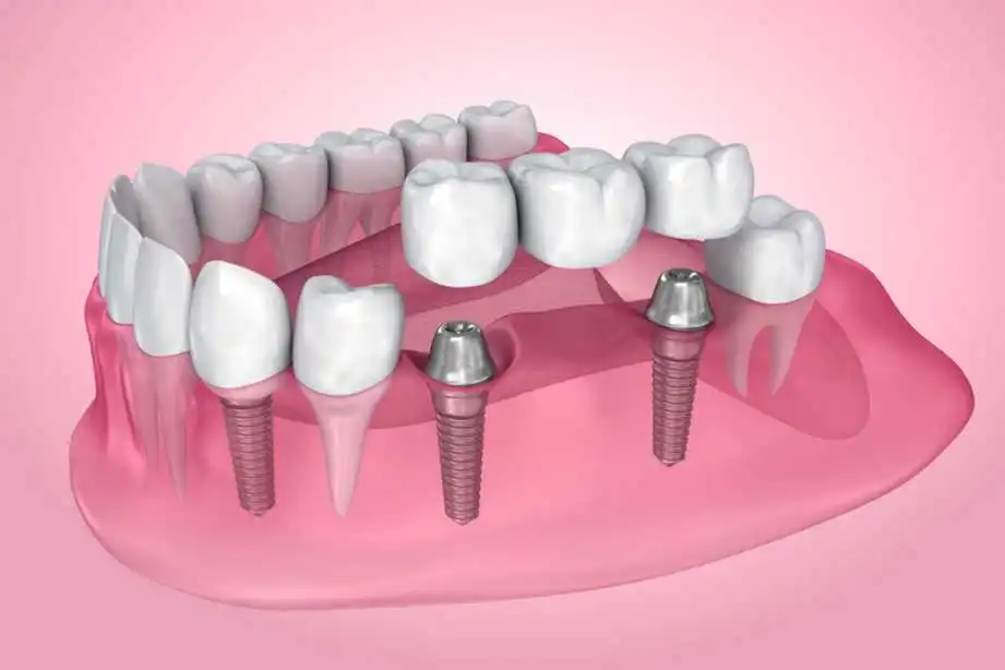 dental-bridges