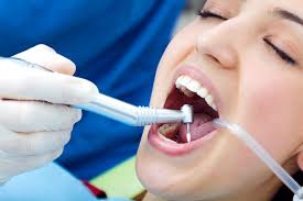 dental-fillings